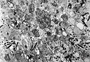 Whipple disease Whipple disease